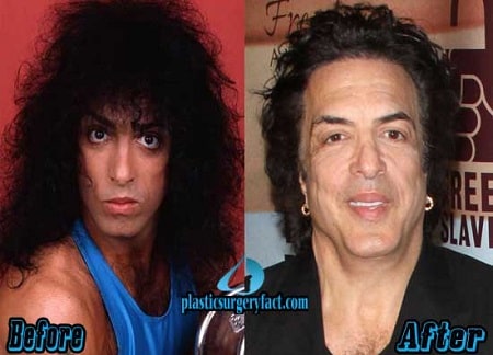 A picture of Paul Stanley before (left) and after (right).